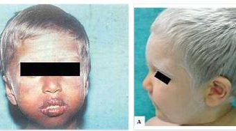 Griscelli Syndrome